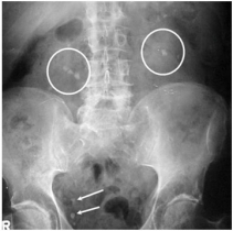 Рентгеновская диагностика мочекаменной болезни