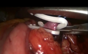 Лапароскопия почки - наложение клипсы на почечную артерию