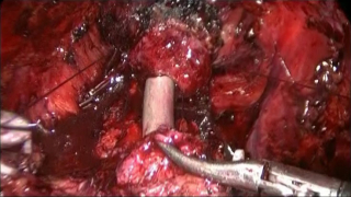 Лапароскопия простаты. Наложены первые 3 шва анастомоза, виден металлический катетер, проведённый через уретру в мочевой пузырь.